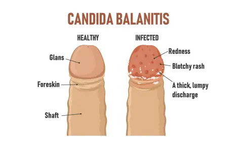 Ilustracja porównuje zdrowy penis z zainfekowanym, pokazując objawy kandydozy: zaczerwienienie, wysypkę i wydzielinę.